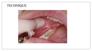 MANDIBULAR NERVE BLOCKS and techniques in dentistry | PPTX