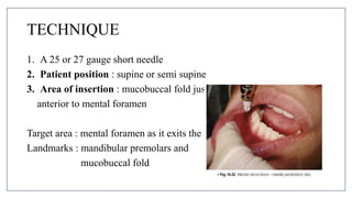 MANDIBULAR NERVE BLOCKS and techniques in dentistry | PPTX