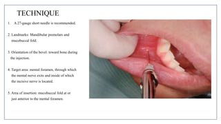 MANDIBULAR NERVE BLOCKS and techniques in dentistry | PPTX