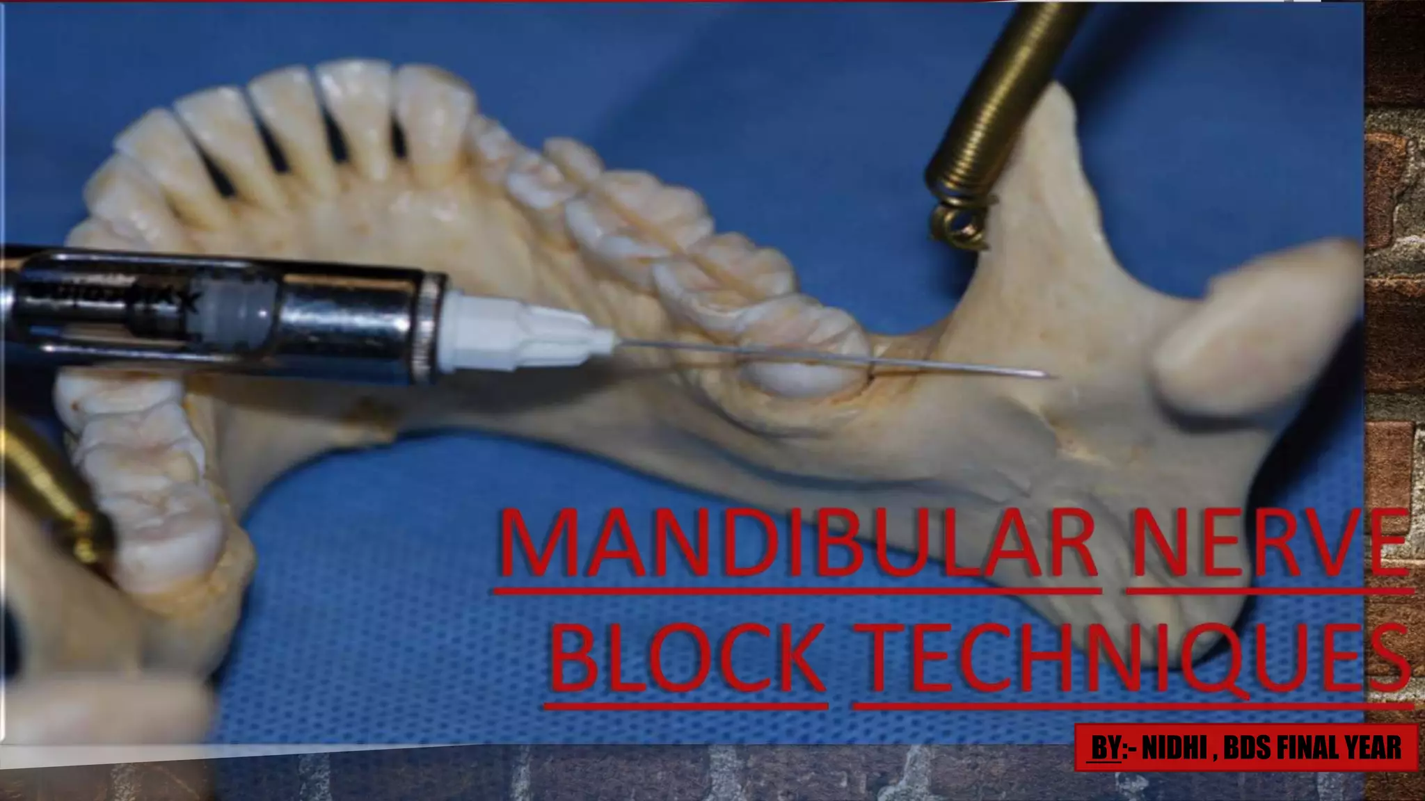 MANDIBULAR NERVE BLOCK TECHNIQUES PPT