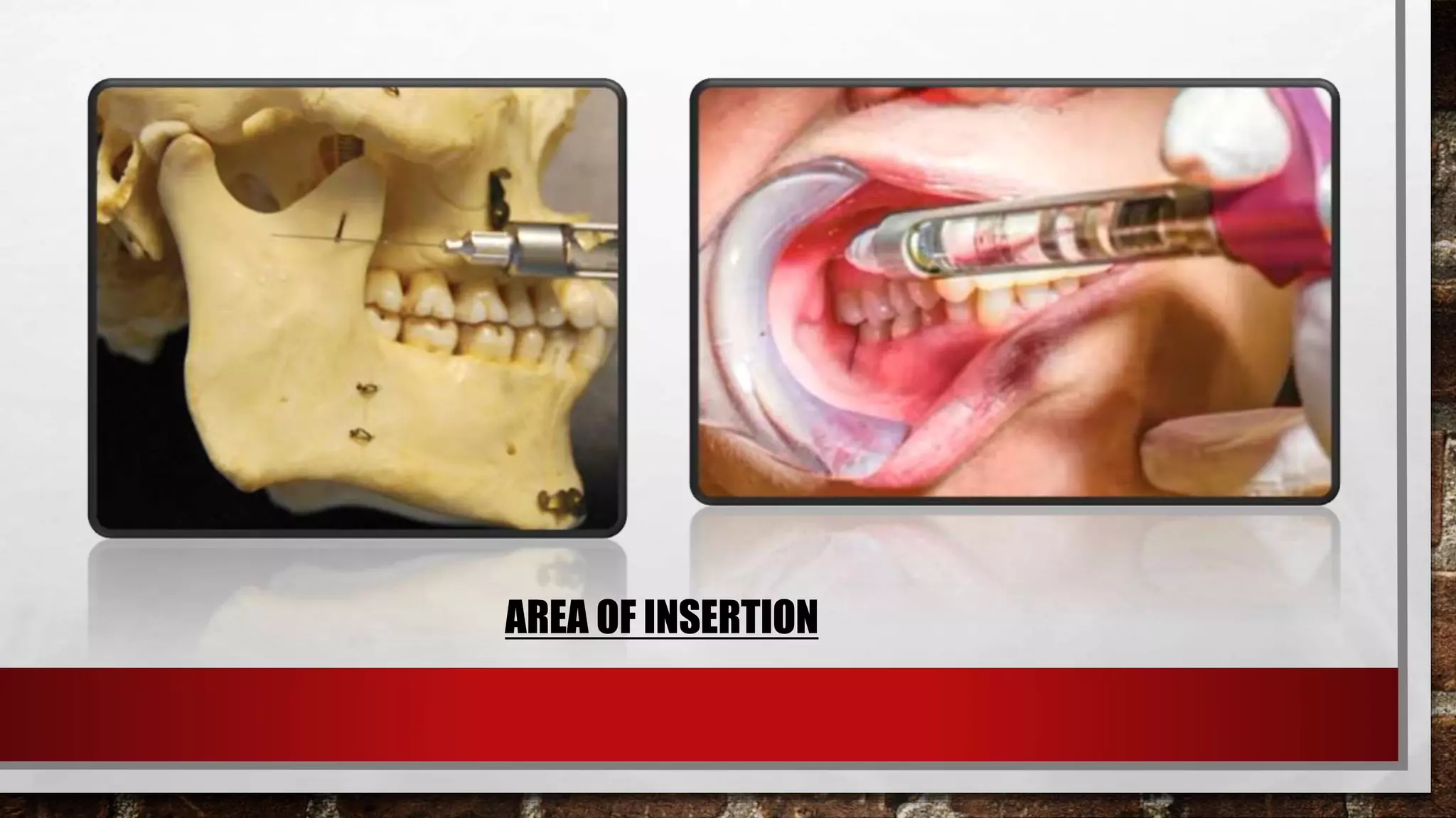 MANDIBULAR NERVE BLOCK TECHNIQUES | PPTX