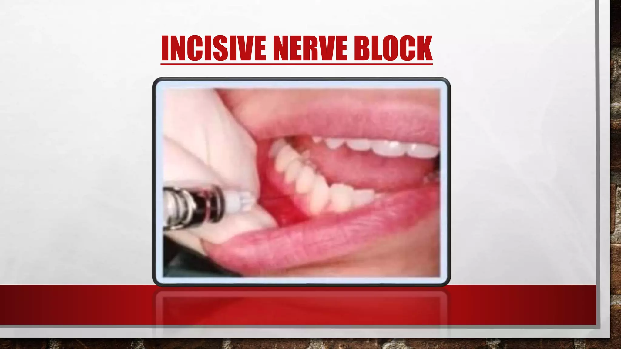 MANDIBULAR NERVE BLOCK TECHNIQUES PPT