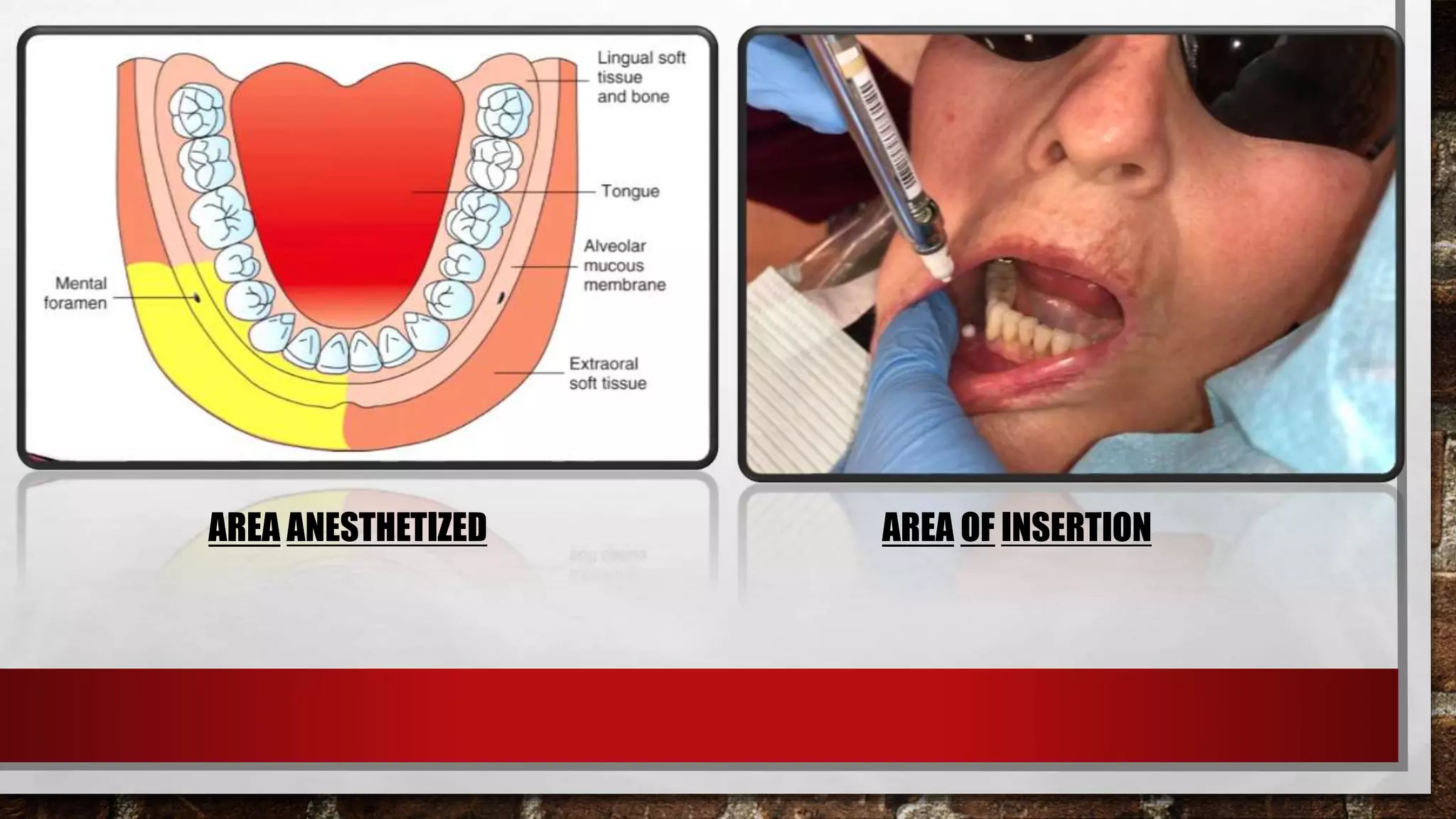 MANDIBULAR NERVE BLOCK TECHNIQUES | PPTX