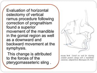 Evaluation of horizontal
osteotomy of vertical
ramus procedure following
correction of prognathism
found a superior
movement of the mandible
in the gonial region as well
as a downward and
backward movement at the
symphysis.
This change is attributed
to the forces of the
pterygomasseteric sling .
 