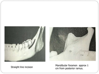 Straight line incision
Mandibular foramen approx 1
cm from posterior ramus.
 