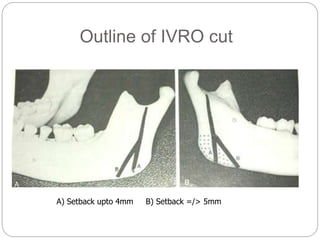 Outline of IVRO cut
A) Setback upto 4mm B) Setback =/> 5mm
 