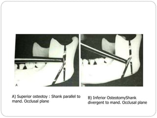 A) Superior osteotoy : Shank parallel to
mand. Occlusal plane
B) Inferior OsteotomyShank
divergent to mand. Occlusal plane
 