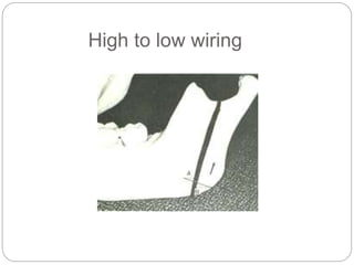 High to low wiring
 