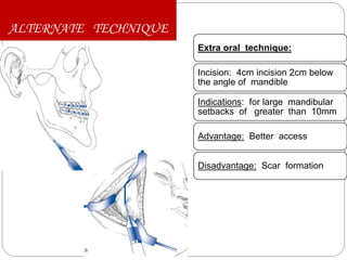 ALTERNATE TECHNIQUE
Extra oral technique:
Incision: 4cm incision 2cm below
the angle of mandible
Indications: for large mandibular
setbacks of greater than 10mm
Advantage: Better access
Disadvantage: Scar formation
 