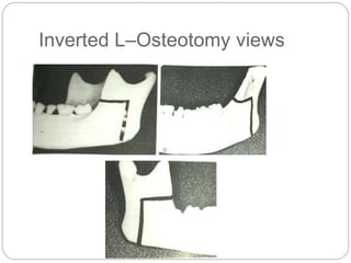 Inverted L–Osteotomy views
 