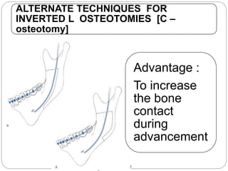 ALTERNATE TECHNIQUES FOR
INVERTED L OSTEOTOMIES [C –
osteotomy]
Advantage :
To increase
the bone
contact
during
advancement
 