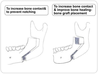 To increase bone contact&
to prevent notching
To increase bone contact
& improve bone healing-
bone graft placement
 
