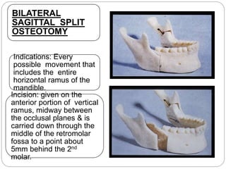 BILATERAL
SAGITTAL SPLIT
OSTEOTOMY
Indications: Every
possible movement that
includes the entire
horizontal ramus of the
mandible.
Incision: given on the
anterior portion of vertical
ramus, midway between
the occlusal planes & is
carried down through the
middle of the retromolar
fossa to a point about
5mm behind the 2nd
molar.
 