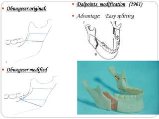  Dalpoints modification (1961)
 Advantage: Easy splitting
 Obwegeser original:
 Obwegeser modified
 