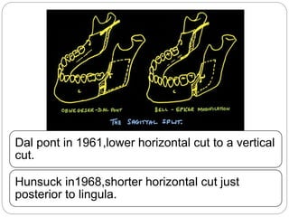 Dal pont in 1961,lower horizontal cut to a vertical
cut.
Hunsuck in1968,shorter horizontal cut just
posterior to lingula.
 