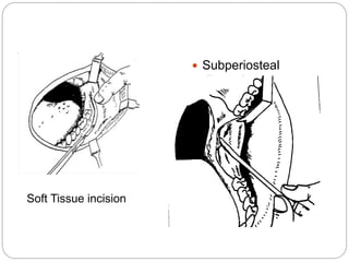 Soft Tissue incision
 Subperiosteal
dissection
 