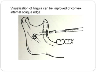 Visualization of lingula can be improved of convex
internal oblique ridge
 