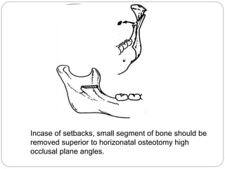 Incase of setbacks, small segment of bone should be
removed superior to horizonatal osteotomy high
occlusal plane angles.
 