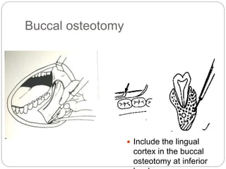 Buccal osteotomy
 Include the lingual
cortex in the buccal
osteotomy at inferior
 