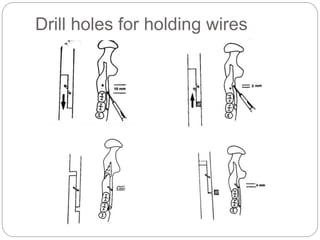 Drill holes for holding wires
 