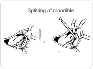 Splitting of mandible
 