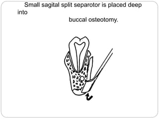 Small sagital split separotor is placed deep
into
buccal osteotomy.
 