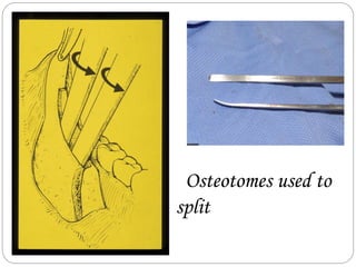 Osteotomes used to
split
 