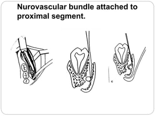 Nurovascular bundle attached to
proximal segment.
 