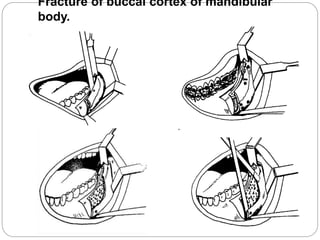 Fracture of buccal cortex of mandibular
body.
 