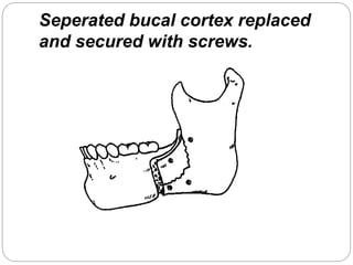Seperated bucal cortex replaced
and secured with screws.
 