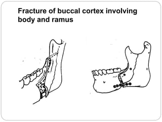 Fracture of buccal cortex involving
body and ramus
 
