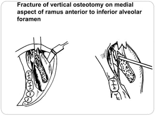 Fracture of vertical osteotomy on medial
aspect of ramus anterior to inferior alveolar
foramen
 