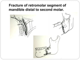 Fracture of retromolar segment of
mandible distal to second molar.
 