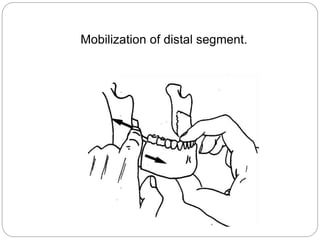 Mobilization of distal segment.
 