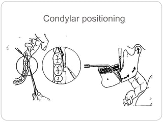 Condylar positioning
 