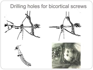 Drilling holes for bicortical screws
 