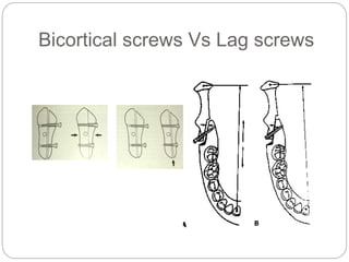 Bicortical screws Vs Lag screws
 