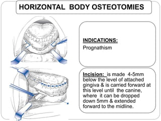 HORIZONTAL BODY OSTEOTOMIES
INDICATIONS:
Prognathism
Incision: is made 4-5mm
below the level of attached
gingiva & is carried forward at
this level until the canine,
where it can be dropped
down 5mm & extended
forward to the midline.
 