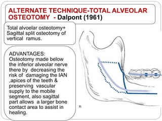 ALTERNATE TECHNIQUE-TOTAL ALVEOLAR
OSTEOTOMY - Dalpont (1961)
Total alvoelar osteotomy+
Sagittal split osteotomy of
vertical ramus.
ADVANTAGES:
Osteotomy made below
the inferior alveolar nerve
there by decreasing the
risk of damaging the IAN
,apices of the teeth &
preserving vascular
supply to the mobile
segment, also sagittal
part allows a larger bone
contact area to assist in
healing.
 