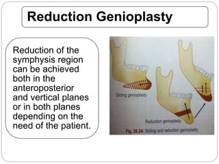 Reduction Genioplasty
Reduction of the
symphysis region
can be achieved
both in the
anteroposterior
and vertical planes
or in both planes
depending on the
need of the patient.
 