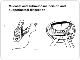 Mucosal and submucosal incision and
subperiosteal dissection
 