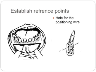 Establish refrence points
 Hole for the
positioning wire
 