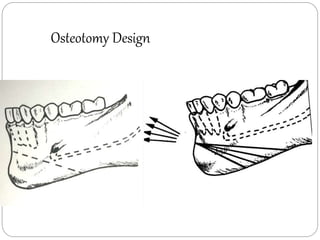 Osteotomy Design
 