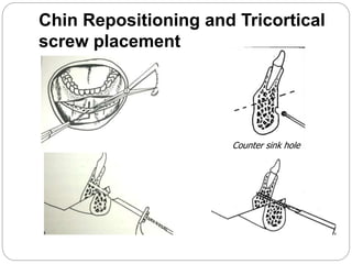 Chin Repositioning and Tricortical
screw placement
Counter sink hole
 