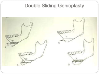 Double Sliding Genioplasty
 