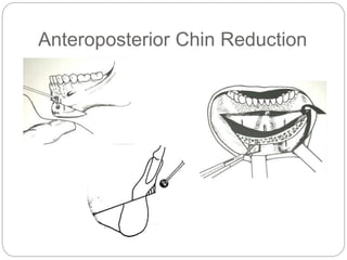 Anteroposterior Chin Reduction
 