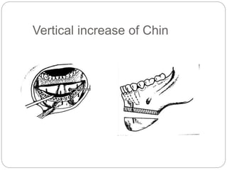 Vertical increase of Chin
 