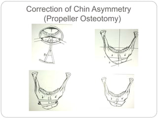 Correction of Chin Asymmetry
(Propeller Osteotomy)
 