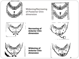 Widening/Narrowing
of Posterior Chin
dimension
Narrowing of
Anterior Chin
dimension
Widening of
Anterior Chin
dimension
 