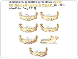 dimensional reduction genioplasty. Keyhan
SO, Khiabani K, Hemmat S, Varedi P , Br J Oral
Maxillofac Surg.2013]
 